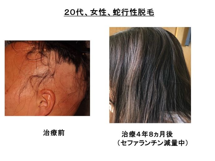 円形脱毛症　病院